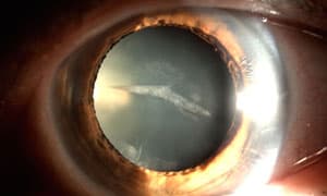 Algunas imágenes de pacientes con cataratas del Dr. Suárez Campo