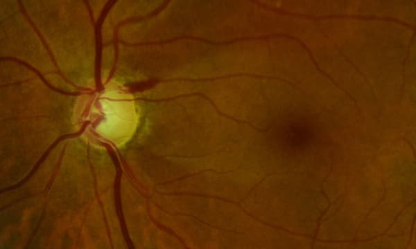Algunos casos de pacientes del oftalmólogo Suárez Campo que padecen glaucoma