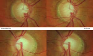 Algunos casos de pacientes del oftalmólogo Suárez Campo que padecen glaucoma