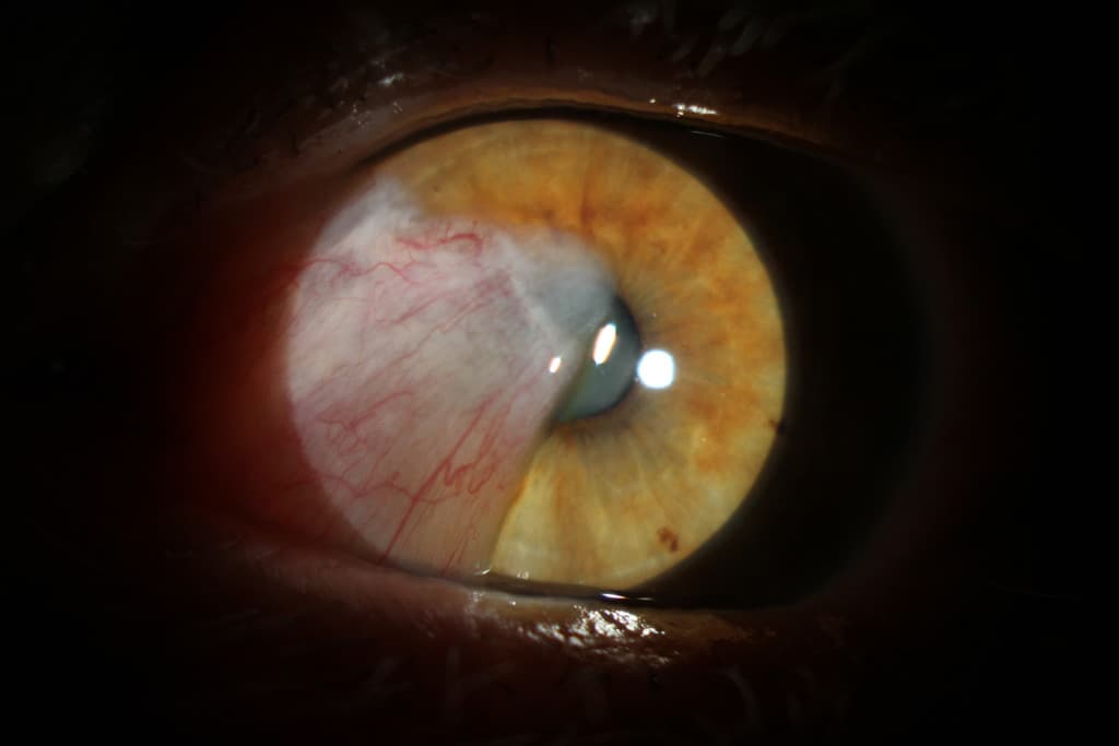 Oftalmólogo especializado en el tratamiento del glaucoma